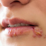 Two people kissing with a warning about infectious diseases transmitted through saliva.