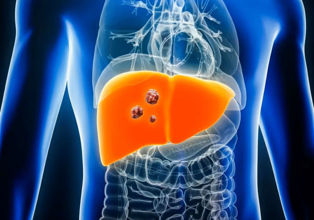 Medical illustration of liver showing cancerous growths.