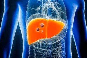 Medical illustration of liver showing cancerous growths.