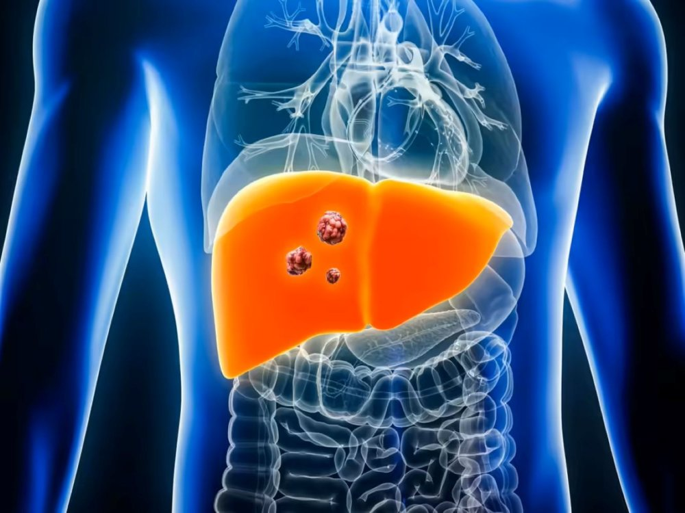 Medical illustration of liver showing cancerous growths.