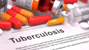 Health workers screening patients for tuberculosis in Rwanda using modern diagnostic equipment