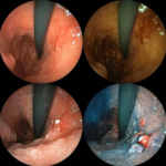 Stomach Cancer