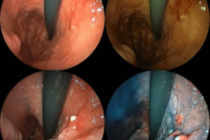 Stomach Cancer