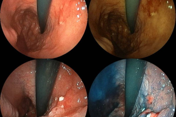 Stomach Cancer