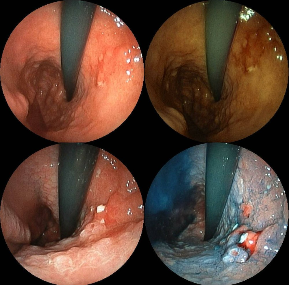 Stomach Cancer